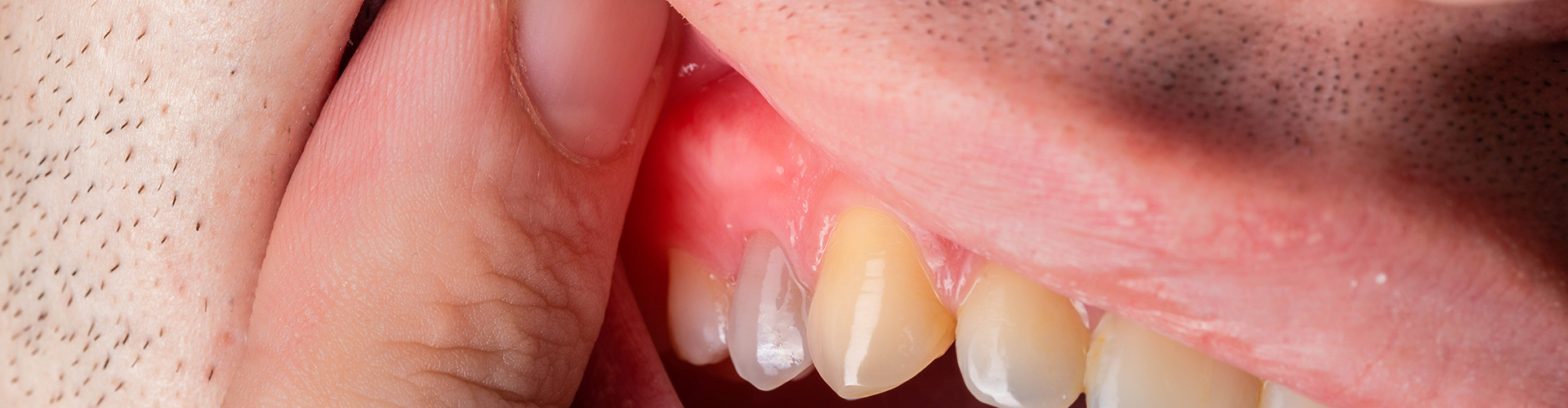 man lifting upper lip to show inflamed gums.